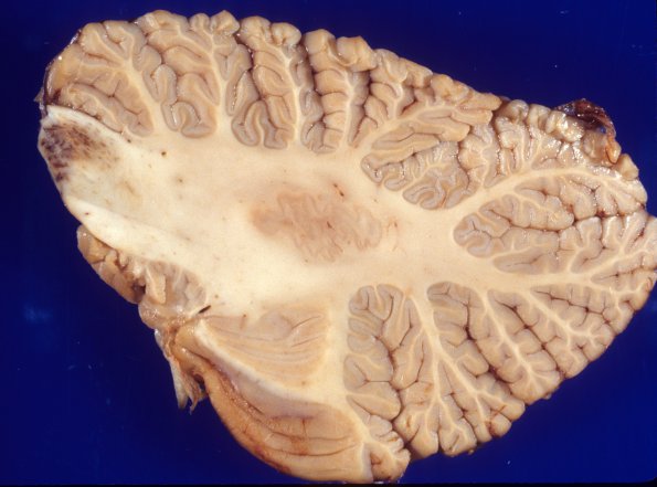 1R1 Acute Hemorrhagic Leukoencephalitis (AHL, Case 1) 10