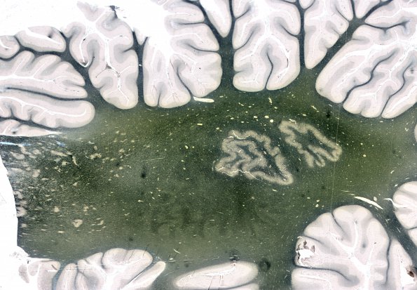 1R2 AHL (Case 1) Loyez Myelin Stain