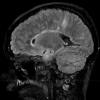 1A3 Acute hemorrhagic leukoencephalitis (AHL, Case 1) T2 Flair - Copy