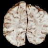 1B5 Acute hemorrhagic leukoencephalitis (AHL, Case 1) 18