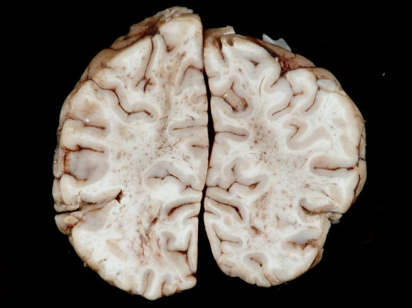 1B5 Acute hemorrhagic leukoencephalitis (AHL, Case 1) 18