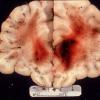 2A1 Acute Hemorrhagic Leukoencephalitis (AHL, Case 2) 4