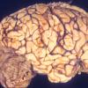 3A1 Acute hemorrhagic leukoencephalitis (AHL) & ADEM (Case 3) 10