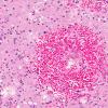 7A5 Acute Hemorrhagic Leukoencephalitis (AHL, AANP 1993, Case 5) H&E X5 3