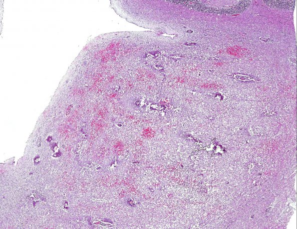 8A1 Acute Hemorrhagic Leukoencephalitis (AHL, AANP 2001 Case 4) H&E X2 3