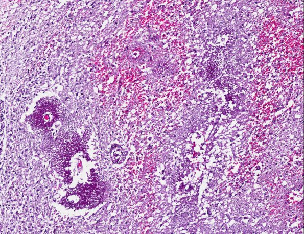 8A3 Acute Hemorrhagic Leukoencephalitis (AHL, AANP 2001 Case 4) H&E X10 1