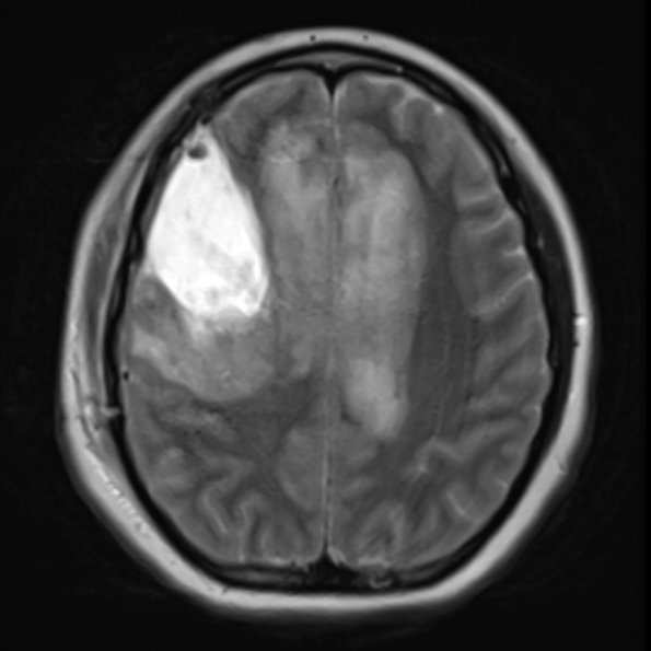 9A6 AHLE (Case 9) MRI T2 7-13-24 (1) - Copy