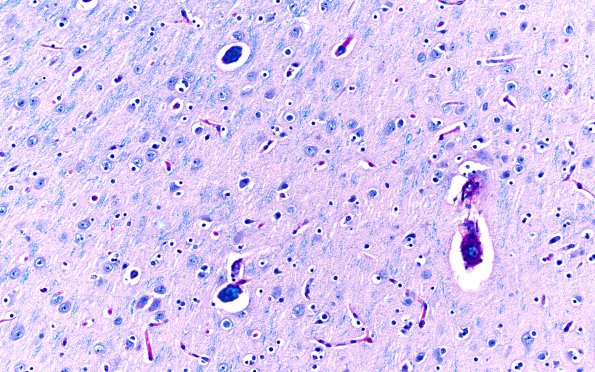 9L1 AHL (Case 9) LFB-PAS Gray Matter 20X 2a