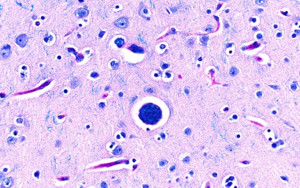 9L3 AHL (Case 9) LFB-PAS Gray Matter 60X 4