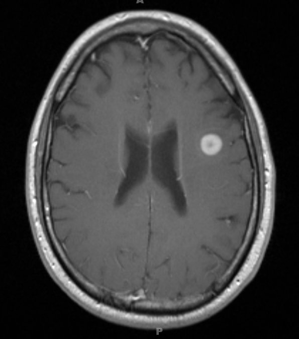 1A2 (Case 1) 4-5-2013 T1 with contrast start - Copy