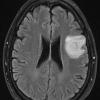 1B1 Balo Concentric Sclerosis (Case 1) FLAIR 1 - Copy