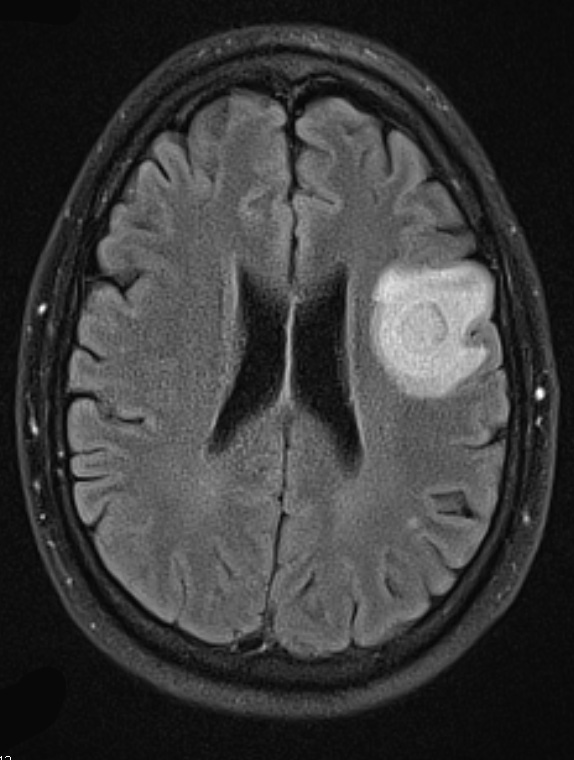 1B1 Balo Concentric Sclerosis (Case 1) FLAIR 1 - Copy