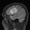 1B2 Balo Concentric Sclerosis (Case 1) MRI 1 FLAIR 2 - Copy