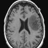 1B3 Balo Concentric Sclerosis (Case 1) T1 2 (2) - Copy