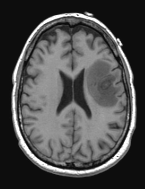 1B3 Balo Concentric Sclerosis (Case 1) T1 2 (2) - Copy