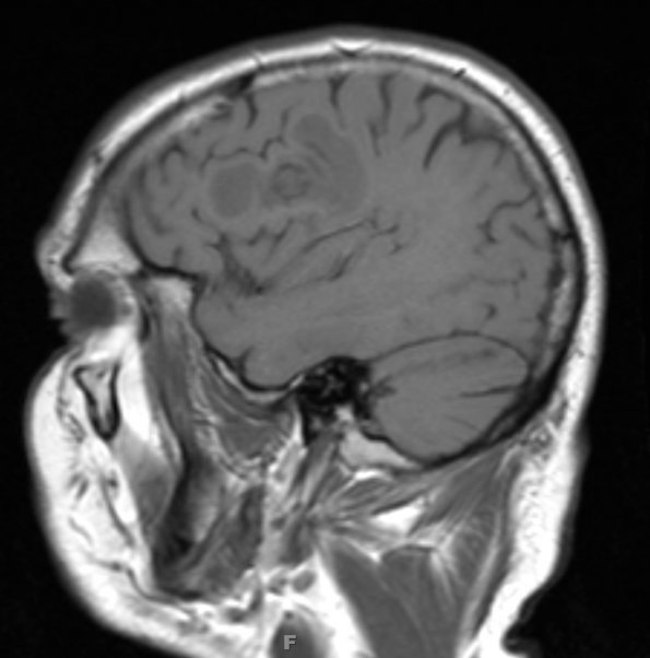 1B4 Balo Concentric Sclerosis (Case 1) T1 3 - Copy