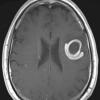 1B5 Balo Concentric Sclerosis (Case 1) T1 W 3 - Copy