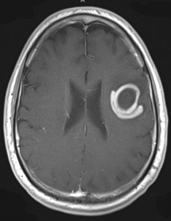 1B5 Balo Concentric Sclerosis (Case 1) T1 W 3 - Copy