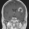 1B6 Balo Concentric Sclerosis (Case 1) MRI 8 T1 With contrast - Copy (2)