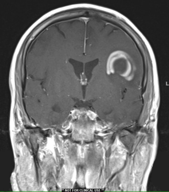 1B6 Balo Concentric Sclerosis (Case 1) MRI 8 T1 With contrast - Copy (2)