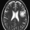 1B7 Balo Concentric Sclerosis (Case 1) T2 2 - Copy