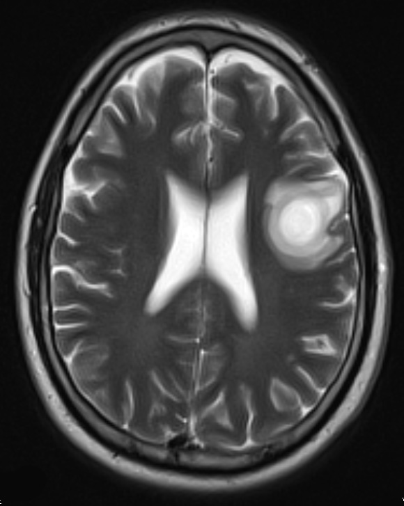 1B7 Balo Concentric Sclerosis (Case 1) T2 2 - Copy