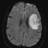 1B8 Balo Concentric Sclerosis (Case 1) Diff Trace 1 - Copy