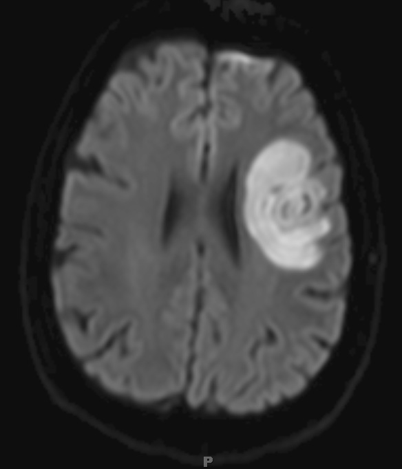 1B8 Balo Concentric Sclerosis (Case 1) Diff Trace 1 - Copy