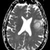 1B9 Balo Concentric Sclerosis (Case 1) DIFFUSION ADC - Copy