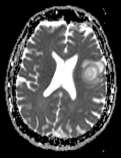 1B9 Balo Concentric Sclerosis (Case 1) DIFFUSION ADC - Copy