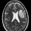 1C Balo Concentric Sclerosis (Case 1) T2 with contrast 3 - Copy