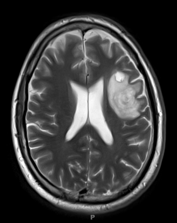 1C Balo Concentric Sclerosis (Case 1) T2 with contrast 3 - Copy