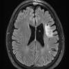 1D1 Balo Concentric Sclerosis (Case 1) 2018 T2 FLAIR 4 - Copy