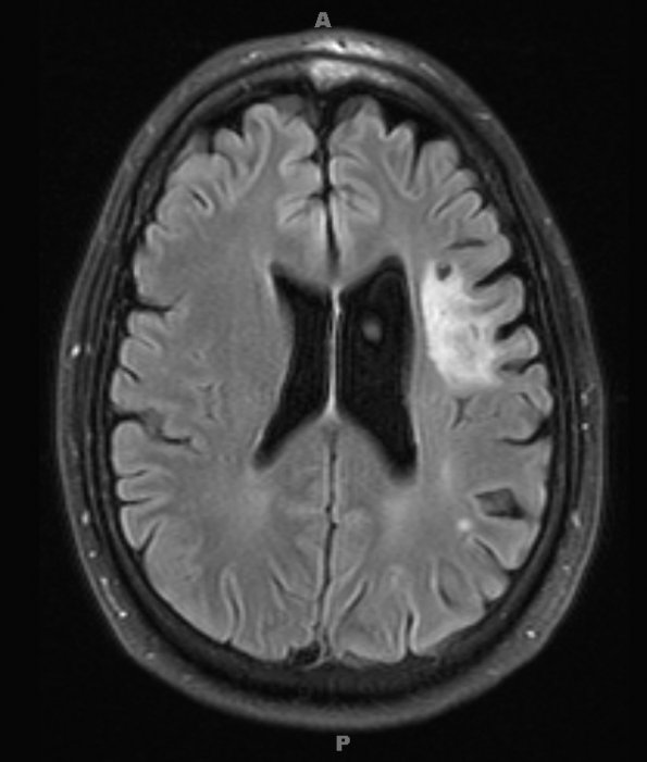 1D1 Balo Concentric Sclerosis (Case 1) 2018 T2 FLAIR 4 - Copy