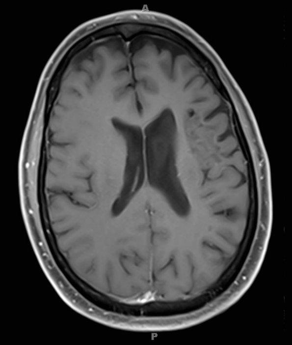 1D2 Balo Concentric Sclerosis (Case 1) 2018 T1 Fat Sat with contrast 3 - Copy