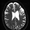 1D3 Balo Concentric Sclerosis (Case 1) 2018 T2 with contrast 2 - Copy