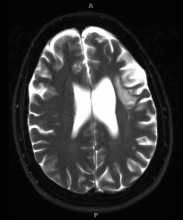 1D3 Balo Concentric Sclerosis (Case 1) 2018 T2 with contrast 2 - Copy