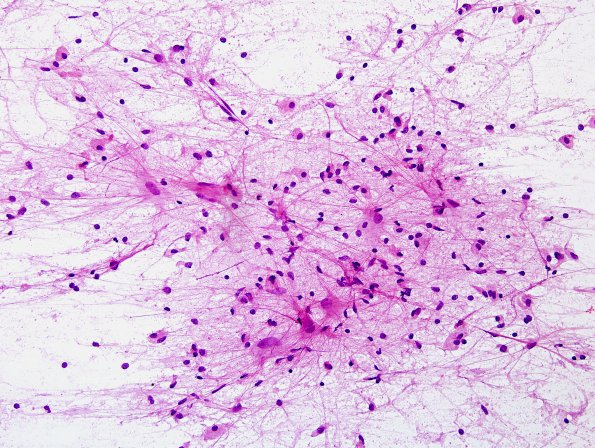 1E1 Balo Concentric Sclerosis (Case 1) H&E smear 9