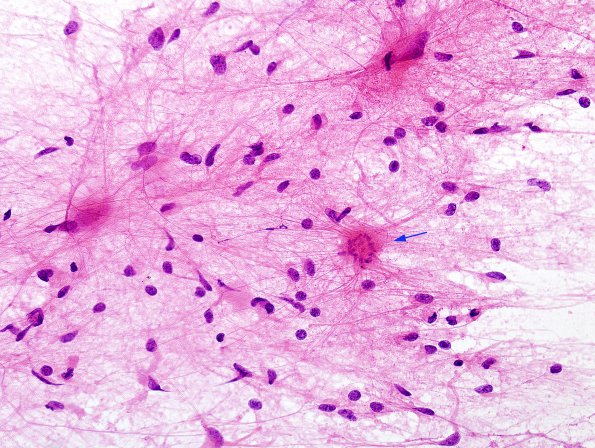 1E2 Balo Concentric Sclerosis (Case 1) H&E smear 10 copy