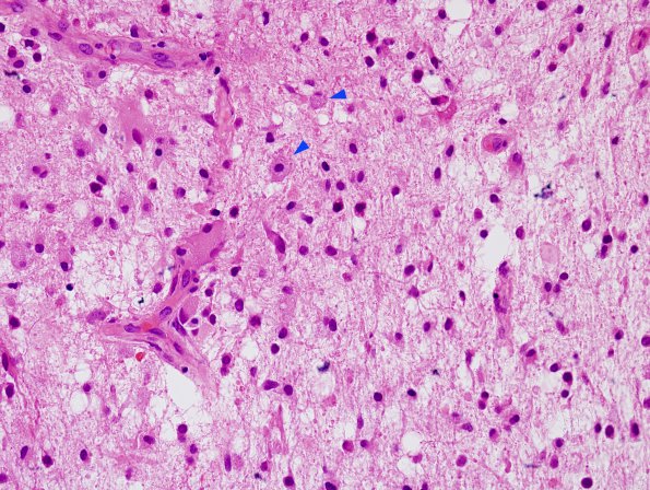 1E5 Balo Concentric Sclerosis (Case 1) H&E 13 copy