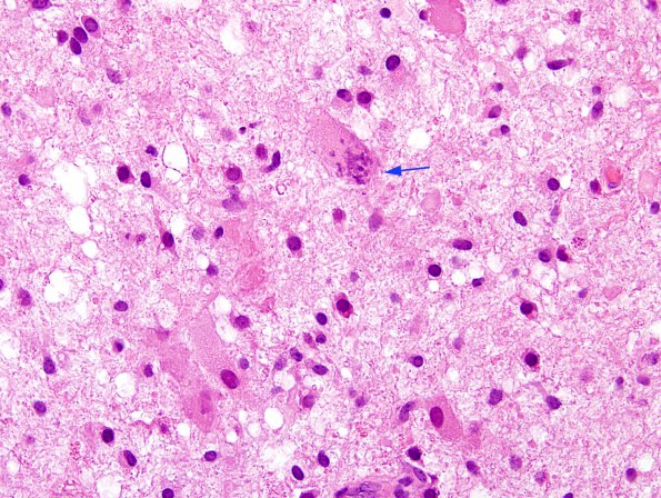 1E6 Balo Concentric Sclerosis (Case 1) H&E 19 copy