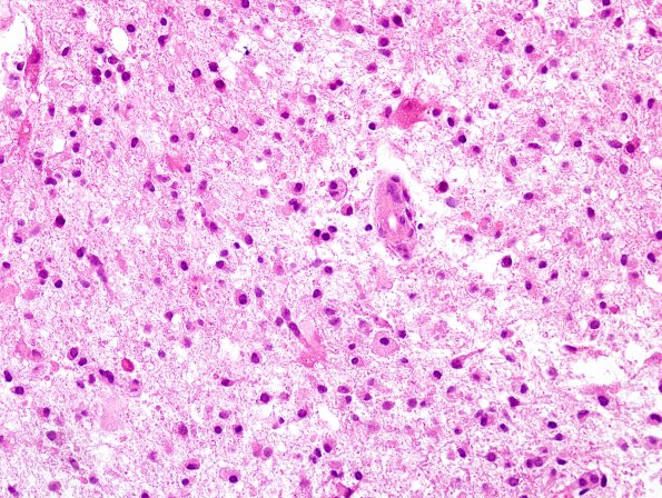 1E7 Balo Concentric Sclerosis (Case 1) H&E 20