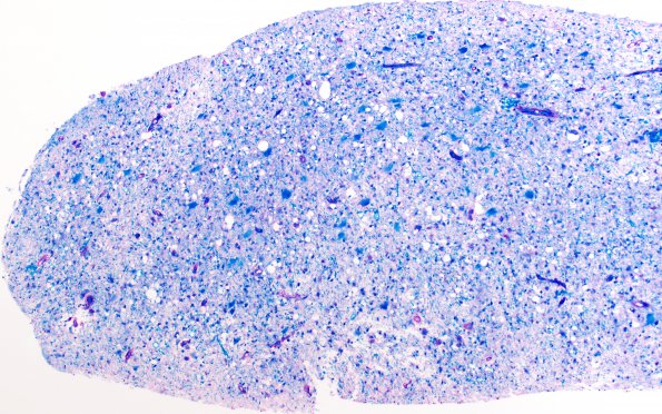 1F1 Balo Concentric Sclerosis (Case 1) B series LFB-PAS 10X