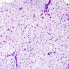 1F4 Balo Concentric Sclerosis (Case 1) match with NF IHC B (LFB-PAS)