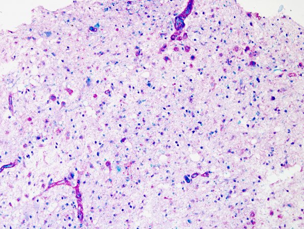 1F4 Balo Concentric Sclerosis (Case 1) match with NF IHC B (LFB-PAS)