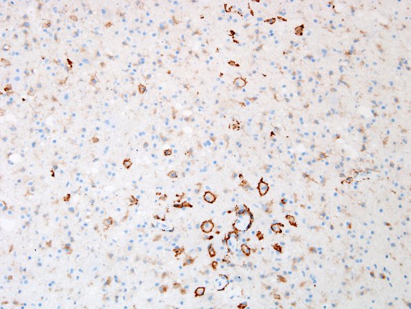 1H3 Balo Concentric Sclerosis (Case 1) CD163 6