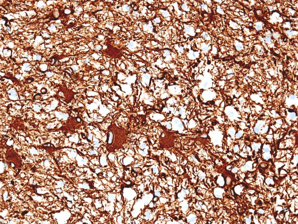 1J2 Balo Concentric Sclerosis (Case 1) GFAP 2