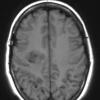 2A1 Balo Concentric Sclerosis (Case 2) T1 - Copy