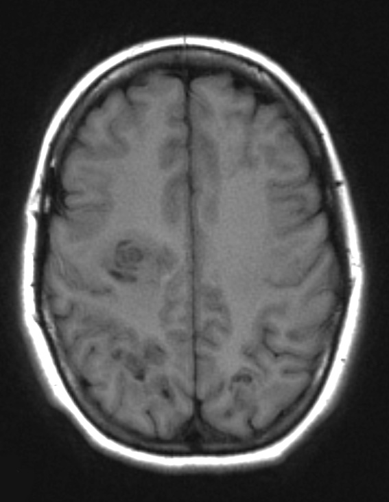 2A1 Balo Concentric Sclerosis (Case 2) T1 - Copy