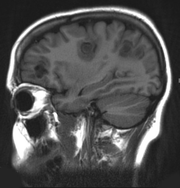 2A2 Balo Concentric Sclerosis (Case 2) T1 BLADE 1 (3) - Copy